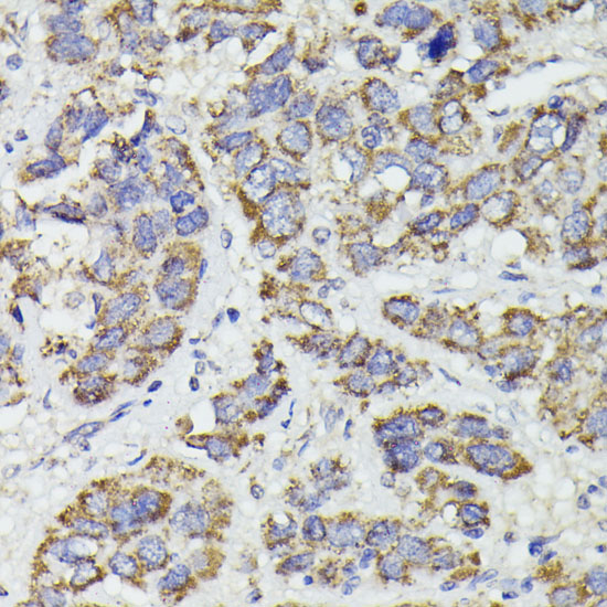 Immunohistochemistry of paraffin-embedded Human liver cancer using SUCLG2 Polyclonal Antibody at dilution of  1:100 (40x lens).