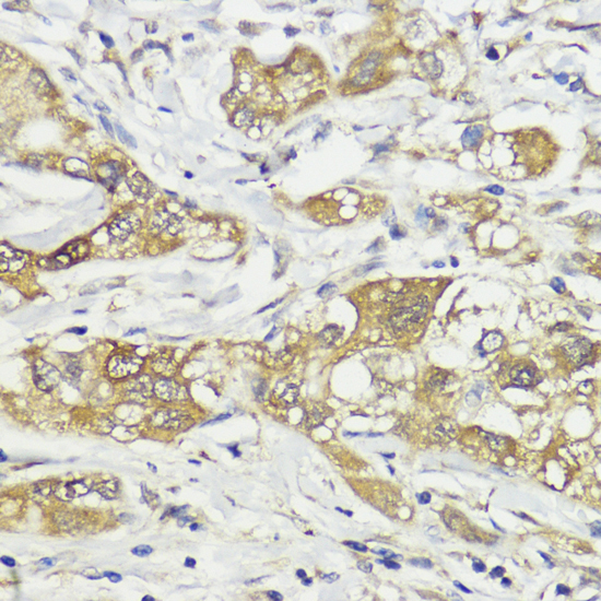 Immunohistochemistry of paraffin-embedded Human liver cancer using HACE1 Polyclonal Antibody at dilution of  1:100 (40x lens).
