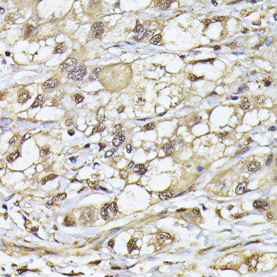 Immunohistochemistry of paraffin-embedded Human liver cancer using PSMB3 Polyclonal Antibody at dilution of  1:100 (40x lens).