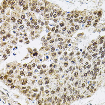 Immunohistochemistry of paraffin-embedded Human lung cancer using BAF60a Polyclonal Antibody at dilution of  1:100 (40x lens).