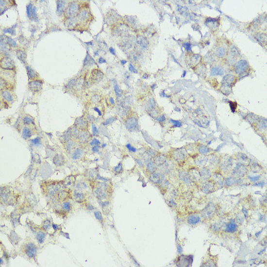 Immunohistochemistry of paraffin-embedded Human mammary cancer using SOCS6 Polyclonal Antibody at dilution of  1:100 (40x lens).