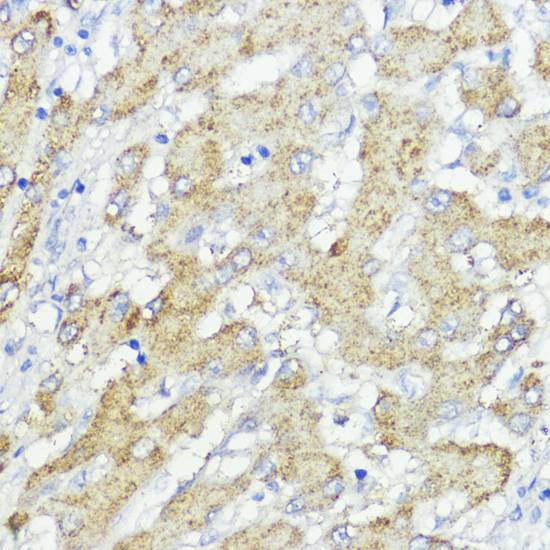 Immunohistochemistry of paraffin-embedded Human liver cancer using SOCS6 Polyclonal Antibody at dilution of  1:100 (40x lens).
