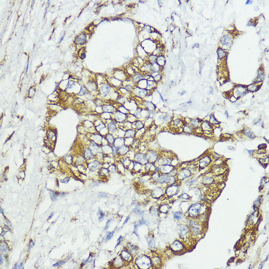 Immunohistochemistry of paraffin-embedded Human lung cancer using SOCS6 Polyclonal Antibody at dilution of  1:100 (40x lens).