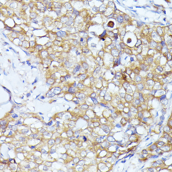 Immunohistochemistry of paraffin-embedded Human mammary cancer using EIF3L Polyclonal Antibody at dilution of  1:100 (40x lens).