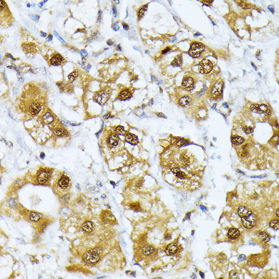Immunohistochemistry of paraffin-embedded Human liver cancer using RRAGD Polyclonal Antibody at dilution of  1:100 (40x lens).