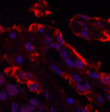 Immunofluorescence analysis of Human lung cancer tissue using Galectin 3 Monoclonal Antibody at dilution of 1:200.