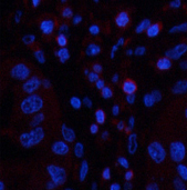 Immunofluorescence analysis of Human liver cancer tissue using CD45 Monoclonal Antibody at dilution of 1:200.