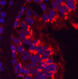 Immunofluorescence analysis of Human lung cancer tissue using CD68 Monoclonal Antibody at dilution of 1:200.