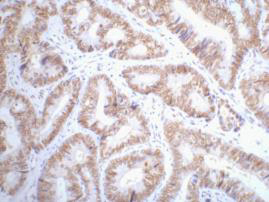 Immunohistochemistry of paraffin-embedded Human colon cancer tissue using p53 Monoclonal Antibody at dilution of 1:200.