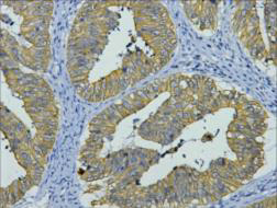 Immunohistochemistry of paraffin-embedded Human colon cancer tissue using CK-8 Monoclonal Antibody at dilution of 1:200.