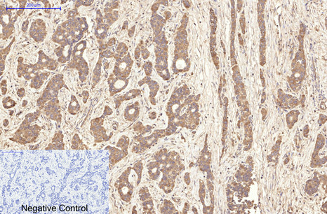 Immunohistochemistry of paraffin-embedded Human liver cancer tissue using AQP4 Monoclonal Antibody at dilution of 1:200.