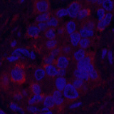 Immunofluorescence analysis of Human liver cancer tissue using FH Monoclonal Antibody at dilution of 1:200.