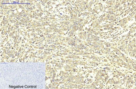 Immunohistochemistry of paraffin-embedded Human breast cancer tissue using ABCB5 Monoclonal Antibody at dilution of 1:200.