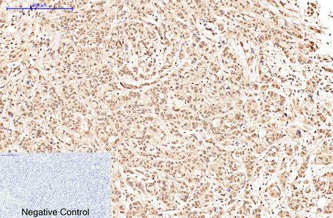 Immunohistochemistry of paraffin-embedded Human breast cancer tissue using Oct-1/2 Monoclonal Antibody at dilution of 1:200.