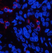 Immunofluorescence analysis of Human lung cancer tissue using LTF Monoclonal Antibody at dilution of 1:200.