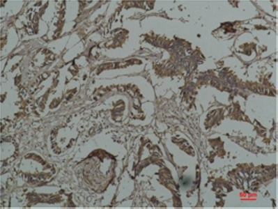 Immunohistochemistry of paraffin-embedded Human breast carcinoma tissue using HSP27 Monoclonal Antibody at dilution of 1:200.