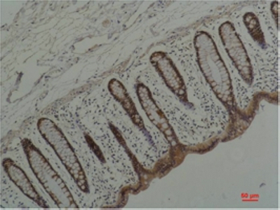 Immunohistochemistry of paraffin-embedded Human colon carcinoma tissue using HSP90 alpha Monoclonal Antibody at dilution of 1:200.