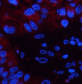 Immunofluorescence analysis of Human liver cancer tissue using CST3 Monoclonal Antibody at dilution of 1:200.