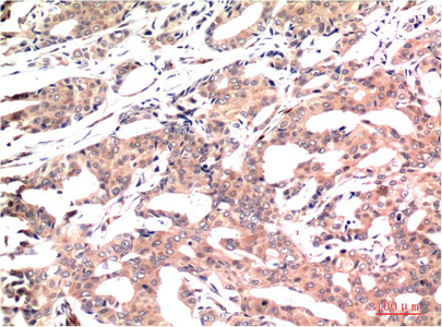 Immunohistochemistry of paraffin-embedded Human breast carcinoma tissue using GSK3 beta Monoclonal Antibody at dilution of 1:200.