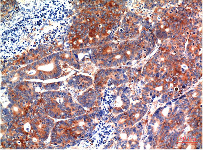 Immunohistochemistry of paraffin-embedded Human stomach carcinoma tissue using GSK3 beta Monoclonal Antibody at dilution of 1:200.