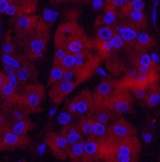 Immunofluorescence analysis of Human stomach cancer tissue using Ubiquitin Monoclonal Antibody at dilution of 1:200.