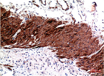 Immunohistochemistry of paraffin-embedded Human colon carcinoma tissue using ACTA1 Monoclonal Antibody at dilution of 1:200.