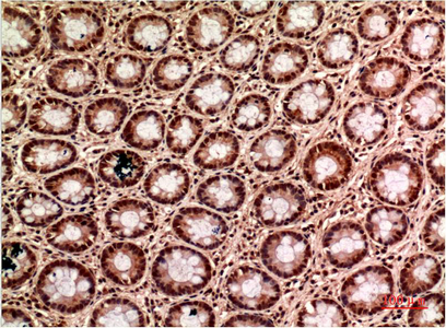 Immunohistochemistry of paraffin-embedded Human colon carcinoma tissue using gamma Tubulin Monoclonal Antibody at dilution of 1:200.