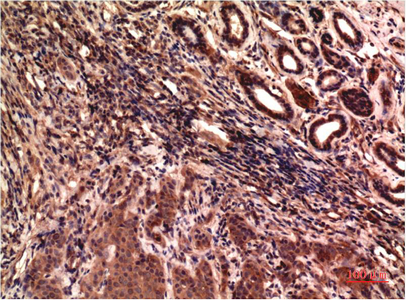 Immunohistochemistry of paraffin-embedded Human breast carcinoma tissue using gamma Tubulin Monoclonal Antibody at dilution of 1:200.