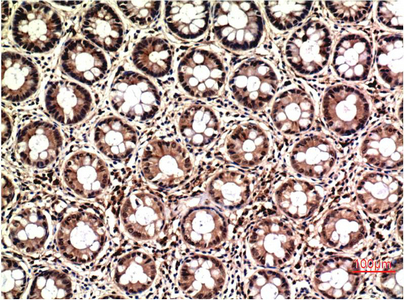 Immunohistochemistry of paraffin-embedded Human colon carcinoma tissue using ERK 1/2 Monoclonal Antibody at dilution of 1:200.