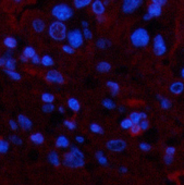 Immunofluorescence analysis of Human liver cancer tissue using TTR Monoclonal Antibody at dilution of 1:200.