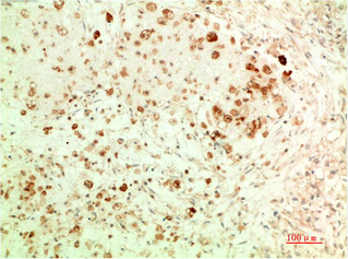 Immunohistochemistry of paraffin-embedded Human ovarian carcinoma tissue using ATG5 Monoclonal Antibody at dilution of 1:200.