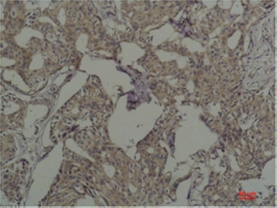 Immunohistochemistry of paraffin-embedded Human breast carcinoma tissue using c-Fos Monoclonal Antibody at dilution of 1:200.