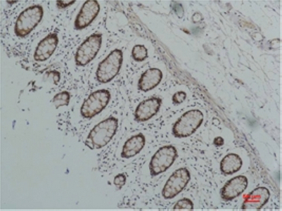 Immunohistochemistry of paraffin-embedded Human colon carcinoma tissue using HSP90 alpha Monoclonal Antibody at dilution of 1:200.