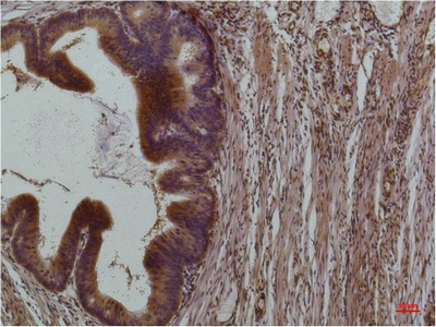 Immunohistochemistry of paraffin-embedded Human colon carcinoma tissue using STAT3 Monoclonal Antibody at dilution of 1:200.