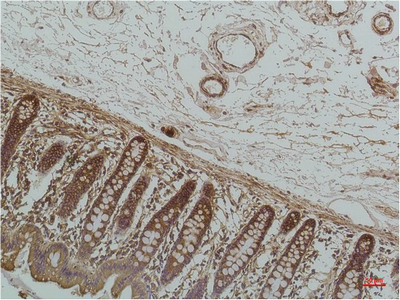 Immunohistochemistry of paraffin-embedded Human colon carcinoma tissue using HSPA5 Monoclonal Antibody at dilution of 1:200.