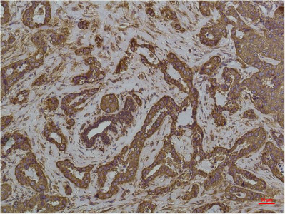 Immunohistochemistry of paraffin-embedded Human breast carcinoma tissue using HSPA5 Monoclonal Antibody at dilution of 1:200.