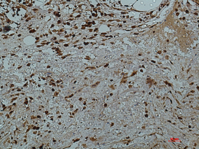 Immunohistochemistry of paraffin-embedded Human colon tissue using Galectin 3 Monoclonal Antibody at dilution of 1:50.