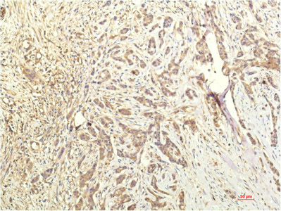 Immunohistochemistry of paraffin-embedded Human breast carcinoma tissue using STAT1 Monoclonal Antibody at dilution of 1:200.