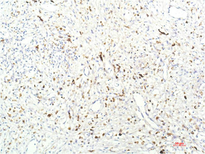 Immunohistochemistry of paraffin-embedded Human breast carcinoma tissue using JAK1 Monoclonal Antibody at dilution of 1:200.