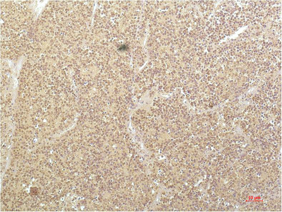 Immunohistochemistry of paraffin-embedded Human kidney carcinoma tissue using SGK1 Monoclonal Antibody at dilution of 1:200.