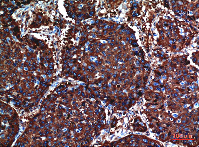 Immunohistochemistry of paraffin-embedded Human lung carcinoma tissue using AKT1 Monoclonal Antibody at dilution of 1:200.