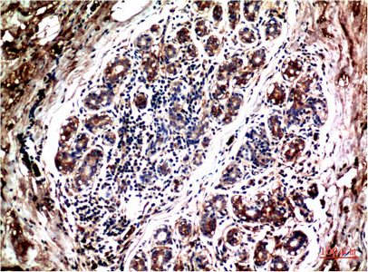 Immunohistochemistry of paraffin-embedded Human breast carcinoma tissue using AKT1 Monoclonal Antibody at dilution of 1:200.