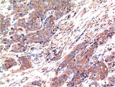 Immunohistochemistry of paraffin-embedded Human breast carcinoma tissue using Bax Monoclonal Antibody at dilution of 1:200.