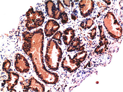 Immunohistochemistry of paraffin-embedded Human prostate tissue using CASP3 Monoclonal Antibody at dilution of 1:200.