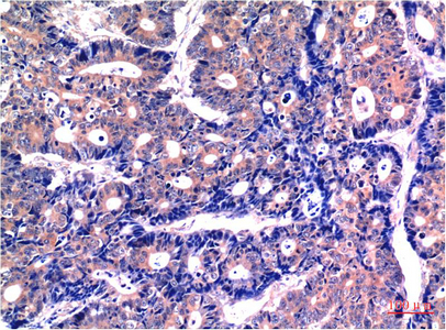 Immunohistochemistry of paraffin-embedded Human stomach carcinoma tissue using GSK3 beta Monoclonal Antibody at dilution of 1:200.