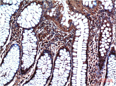 Immunohistochemistry of paraffin-embedded Human stomach carcinoma tissue using GSK3 beta Monoclonal Antibody at dilution of 1:200.