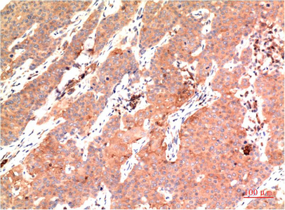 Immunohistochemistry of paraffin-embedded Human breast carcinoma tissue using Epsilon Tubulin Monoclonal Antibody at dilution of 1:200.