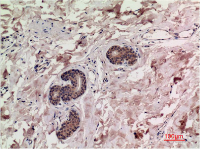 Immunohistochemistry of paraffin-embedded Human breast carcinoma tissue using Smad3 Monoclonal Antibody at dilution of 1:200.