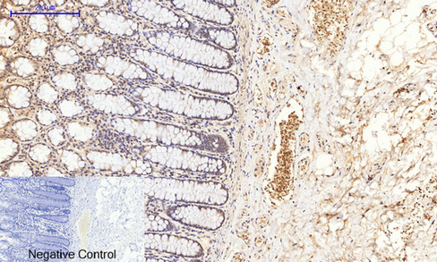 Immunohistochemistry of paraffin-embedded Human colon tissue  using Phospho-GSK3 beta (Ser9) Polyclonal Antibody at dilution of 1:200