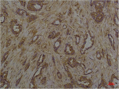 Immunohistochemistry of paraffin-embedded Human breast carcinoma tissue with Phosphoserine Monoclonal Antibody at dilution of 1:200